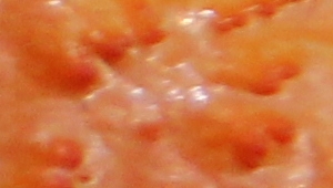 Read more about the article KI bei Colitis Ulcerosa