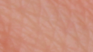 Read more about the article KI in der Dermatologie 2017