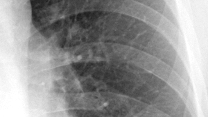 Read more about the article KI erkennt Lungenkrebs in CT-Scans