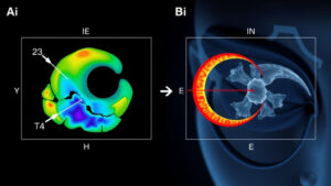 KI in der Augenheilkunde